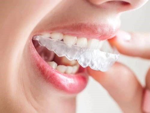 ابتسامة أجمل تبدأ مع التقويم الشفاف في عيادة صحتنا