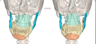 جراحات الفكين وأثرها على مسار التنفس