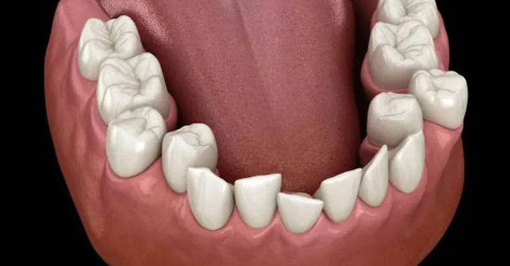 تأثير تزاحم الأسنان على صحة اللثة وتكوّن الجيوب اللثوية