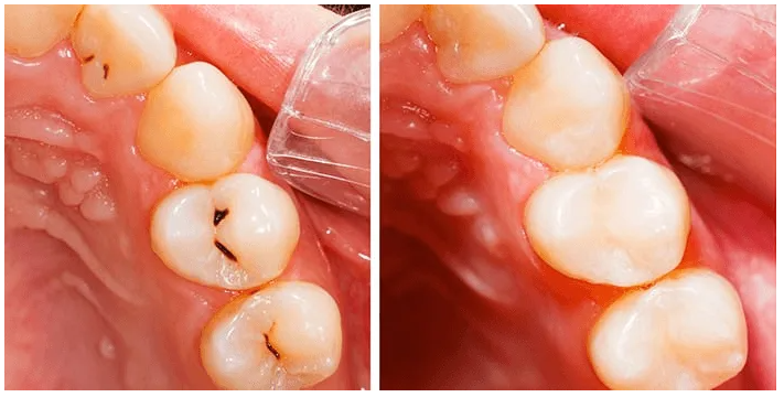الألم بعد حشوات الأسنان: أسبابه وطرق التعامل معه