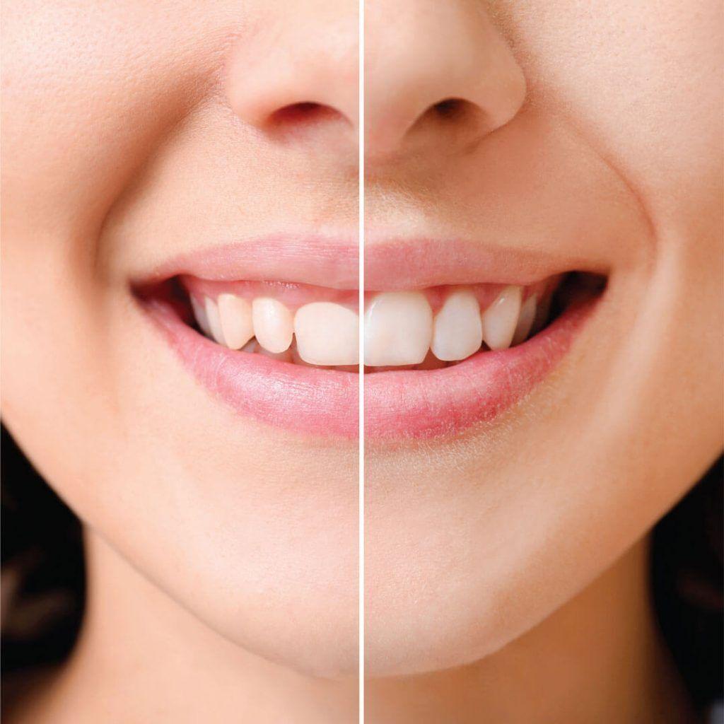 جراحة اللثة وتصحيح الابتسامة اللثوية